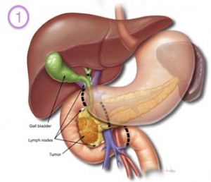 Pancreatic cancer surgery, whipples