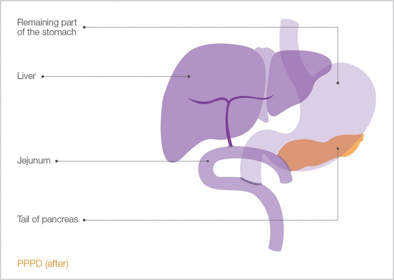 Surgical Diagram of Whipple's Procedure
