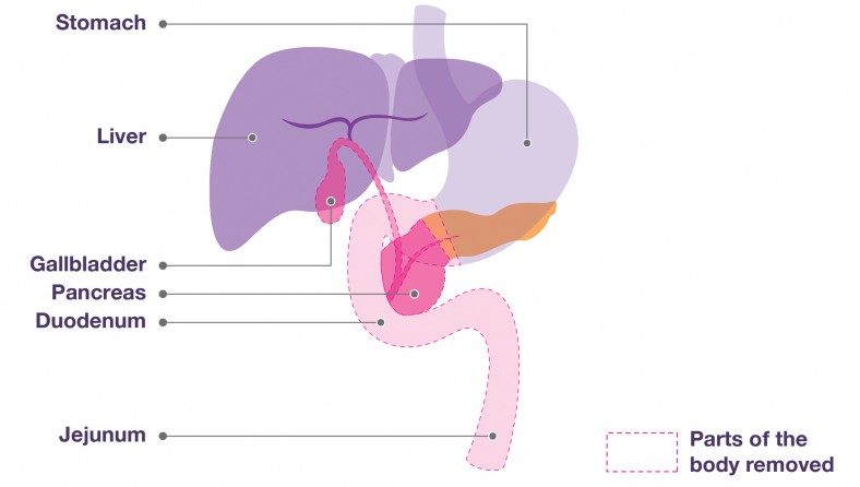 Surgical Diagram of Whipple's Procedure