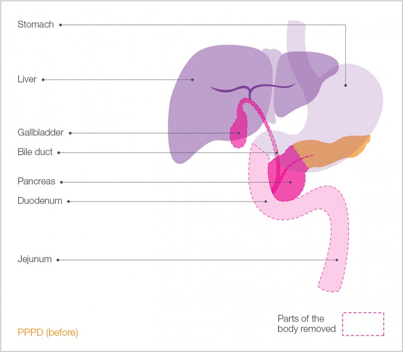 Surgical Diagram of Whipple's Procedure