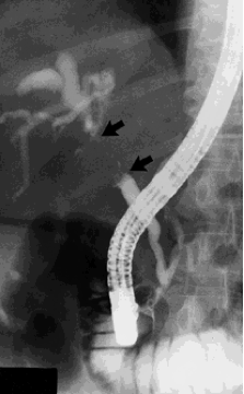An ERCP X-Ray