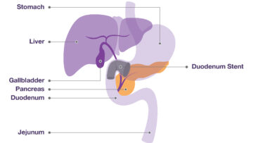 Diagram of the position of a Duodenal Stent