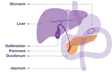 Diagram of the location of a Gastro-jejunostomy