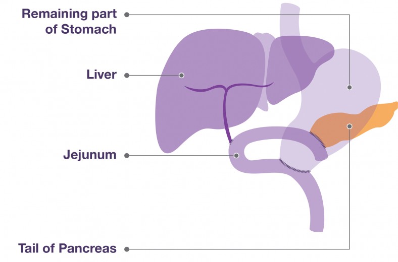 Diagram of organs after a Whipple's procedure