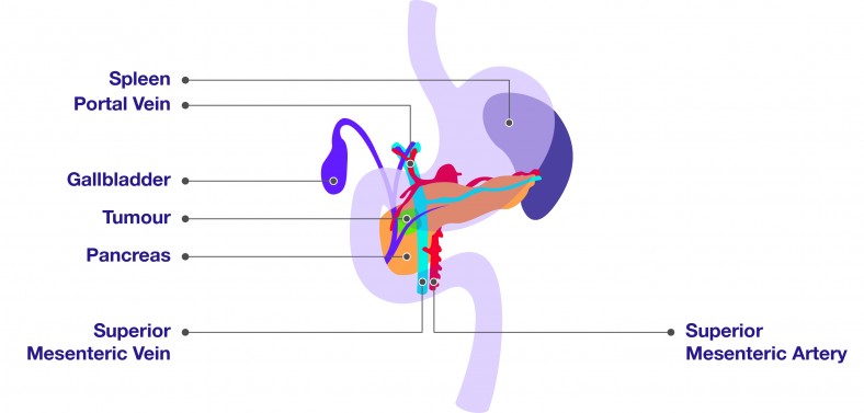 Vein resection: Location of pancreas in relation to the major blood vessels