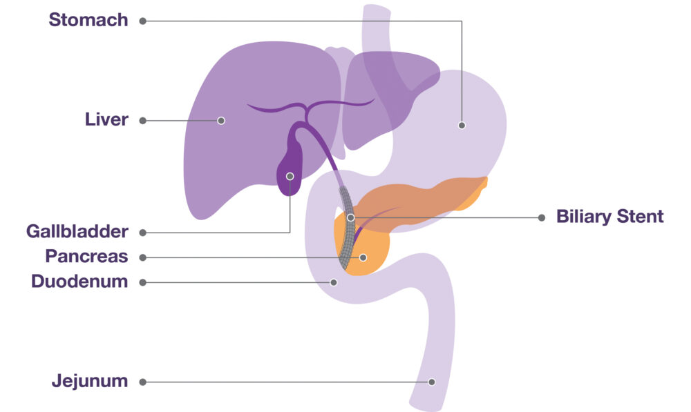 An diagram depicting treating jaundice with a biliary stent.
