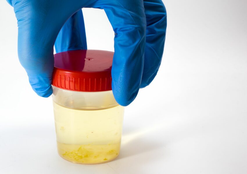 Pancreatic cancer urine color