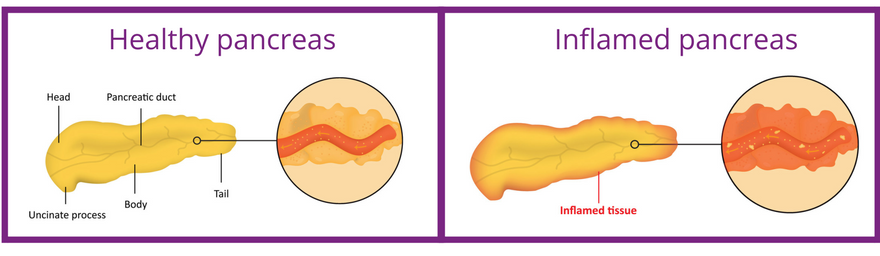 A diagram to show the difference in a healthy and unhealthy pancreas for - is there a link between pancreatitis and pancreatic cancer. 